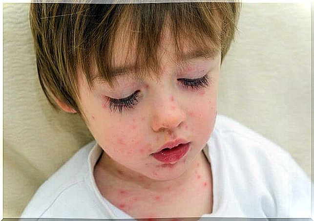 infectious diseases: spotted boy