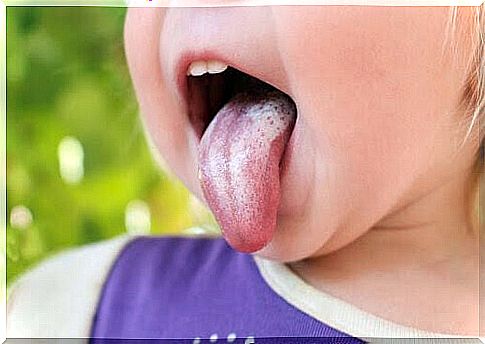 candidiasis on children's tongue