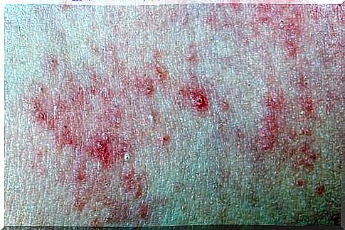 Chronic hives in children: causes and treatment