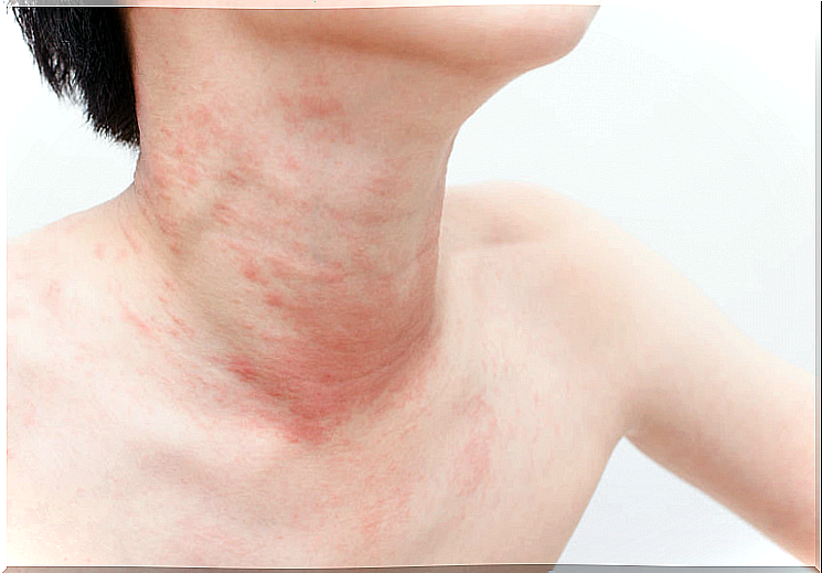 Hives on the neck and upper body