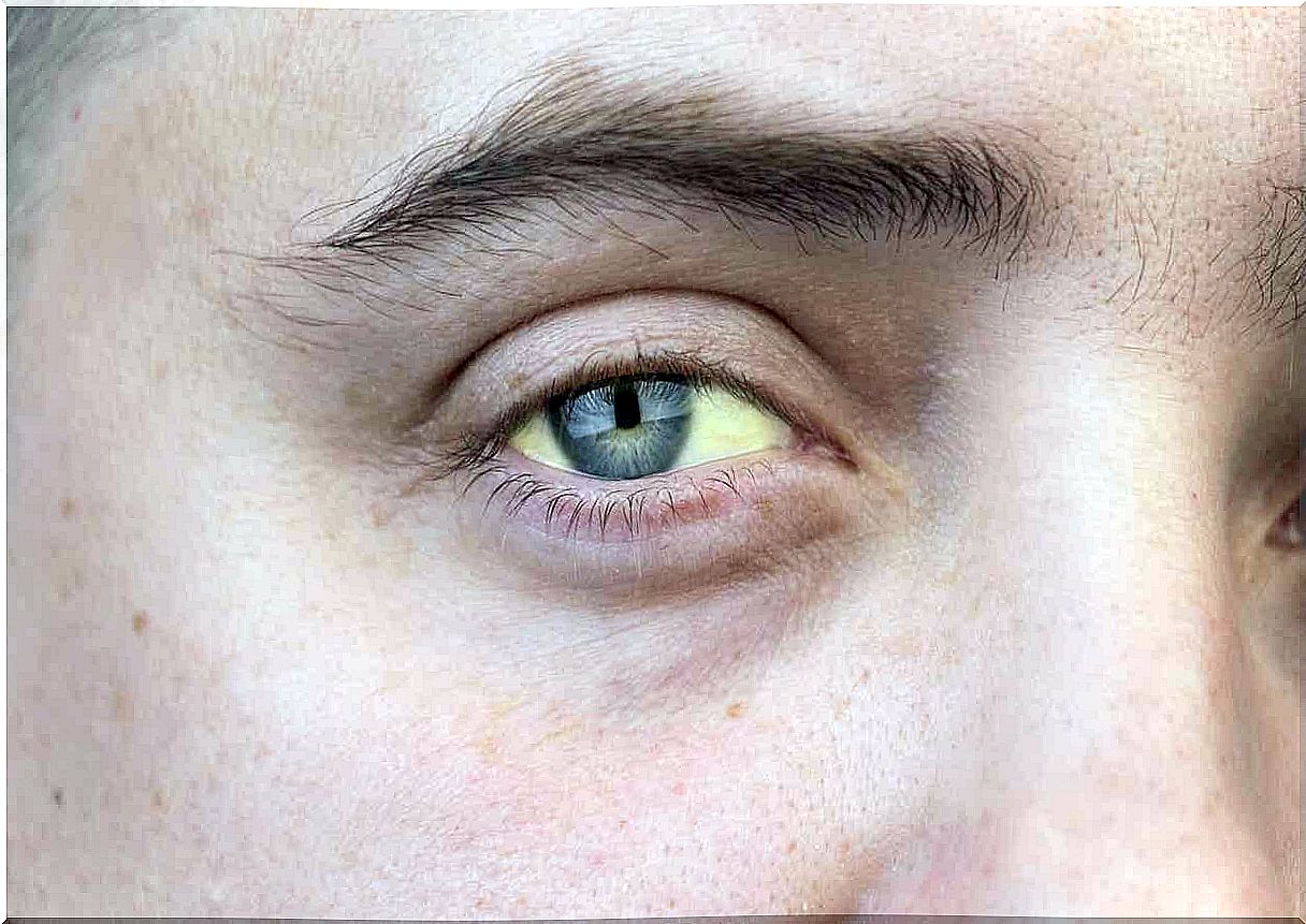 Yellow eyes due to hepatitis.