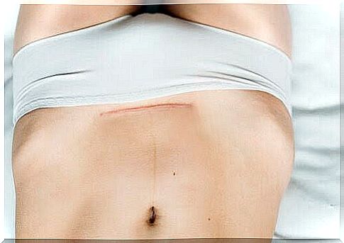 stomach with scars after a cesarean section