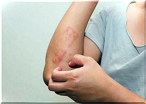 Psoriasis in children: What it is and how children are affected