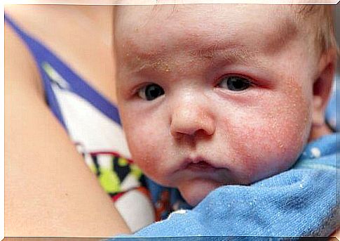 Flaking skin is common in newborns.